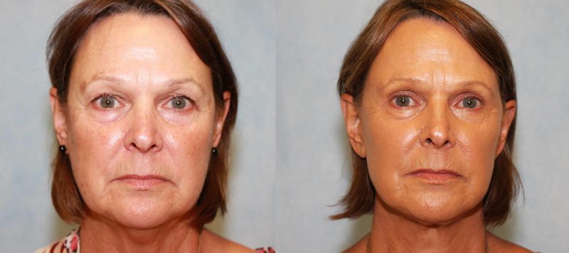 Facelift Patient 9 Image 1