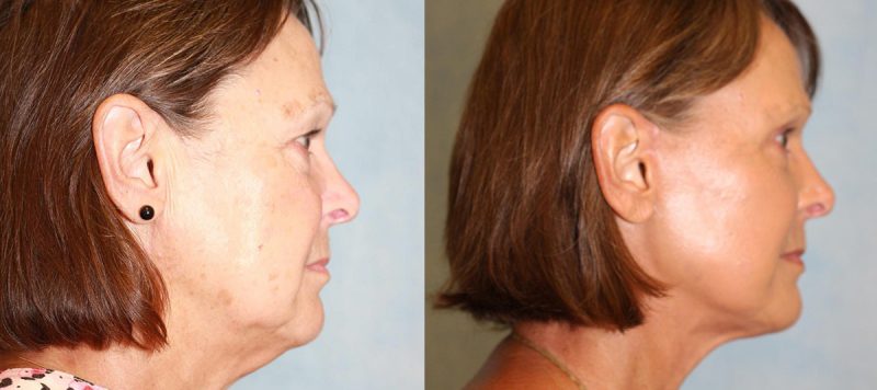 Facelift Patient 9 Image 0