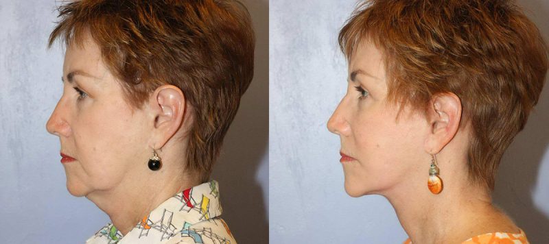 Facelift Patient 5 Image 4