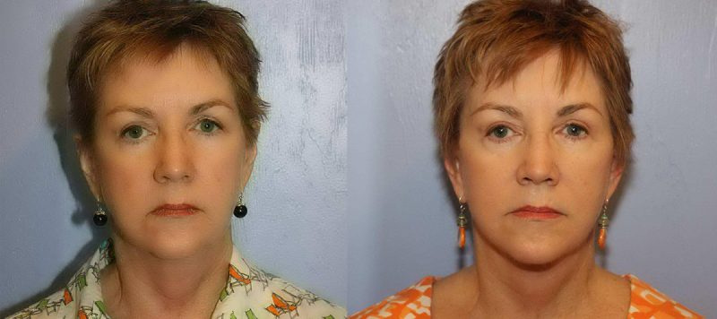 Facelift Patient 5 Image 3