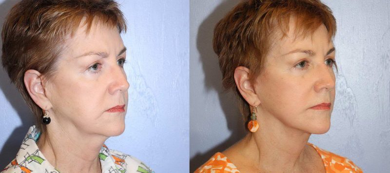 Facelift Patient 5 Image 2