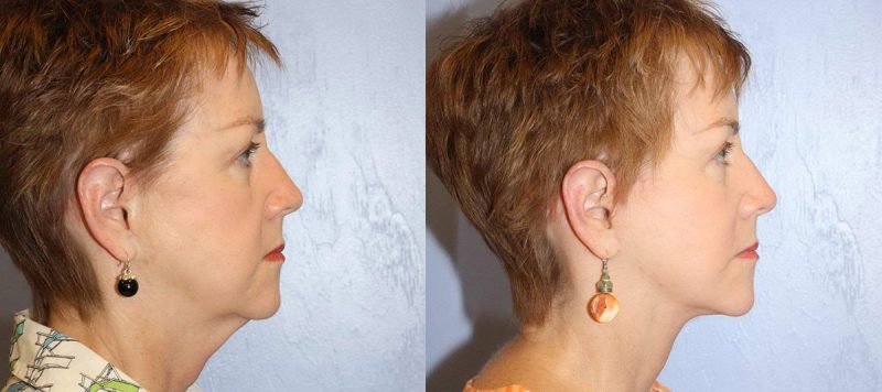 Facelift Patient 5 Image 1