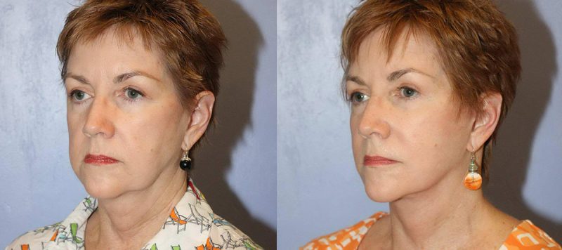 Facelift Patient 5 Image 0