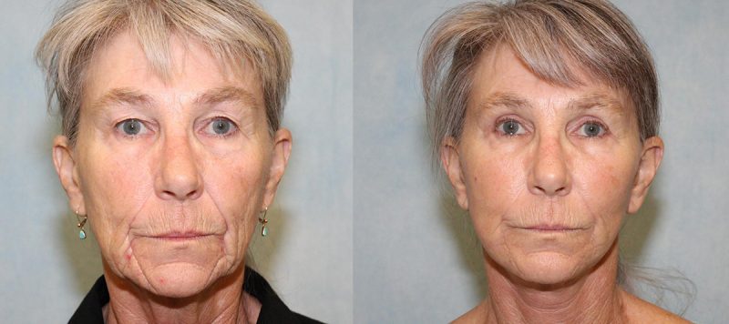 Facelift Patient 4 Image 4