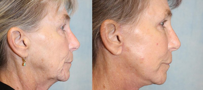 Facelift Patient 4 Image 3