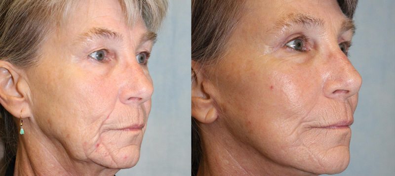 Facelift Patient 4 Image 2