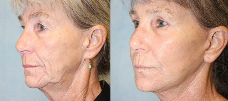 Facelift Patient 4 Image 1