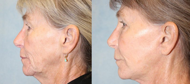 Facelift Patient 4 Image 0