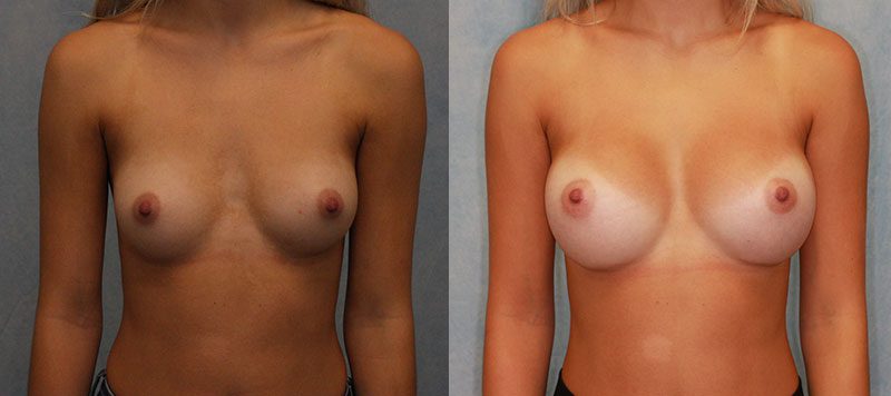 Breast Augmentation Patient 24 Image 0