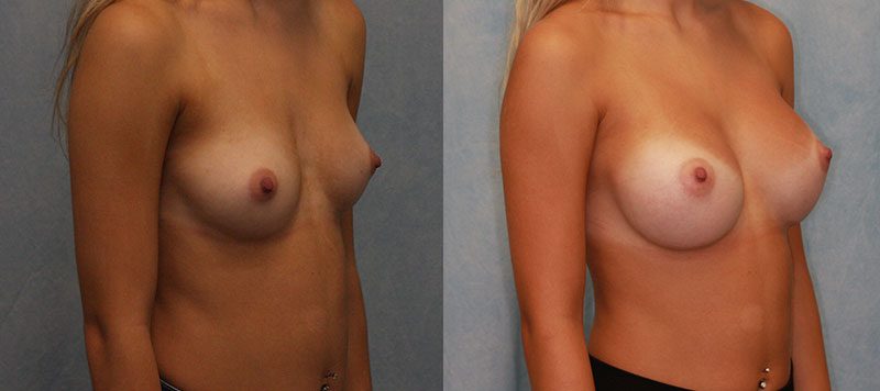 Breast Augmentation Patient 24 Image 1
