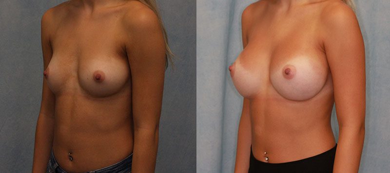 Breast Augmentation Patient 24 Image 3