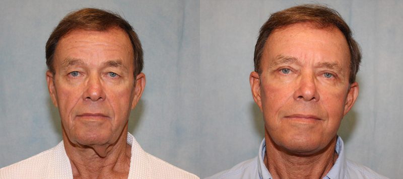 Facelift Patient 6 Image 0