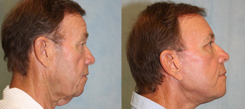 Facelift Patient 6 Image 1