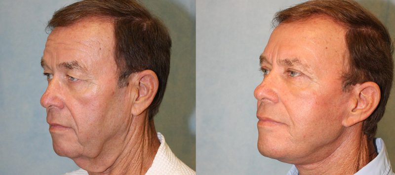 Facelift Patient 6 Image 3