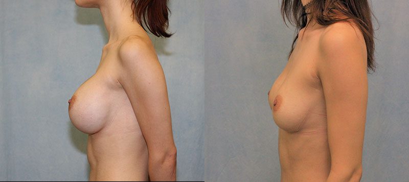 Breast Implant Removal Patient 3 Image 3