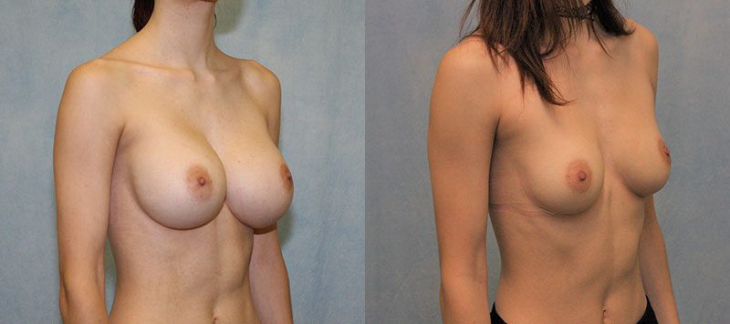 Breast Implant Removal Patient 3 Image 0