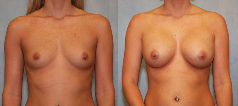 Breast Augmentation Patient 12 Image 2