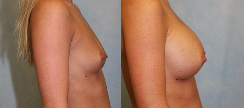 Breast Augmentation Patient 12 Image 1