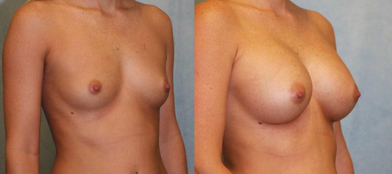 Breast Augmentation Patient 12 Image 0