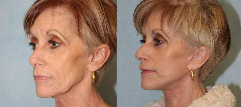 Facelift Patient 1 Image 4