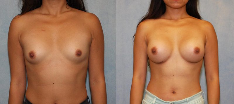 Breast Augmentation Patient 4 Image 3