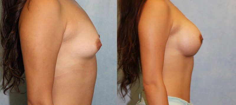 Breast Augmentation Patient 4 Image 1