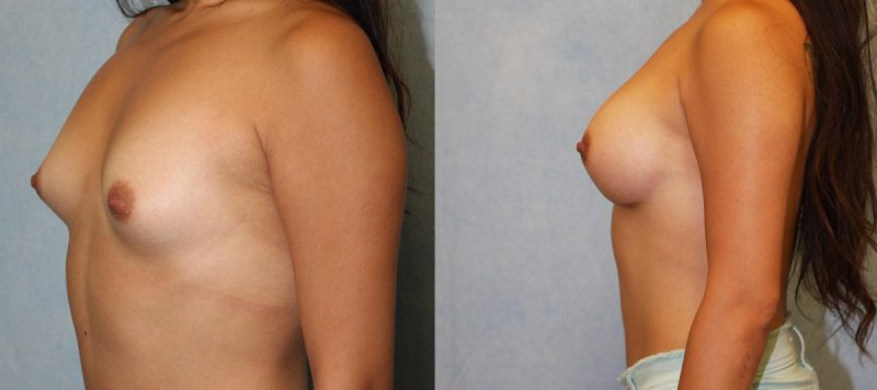 Breast Augmentation Patient 4 Image 0
