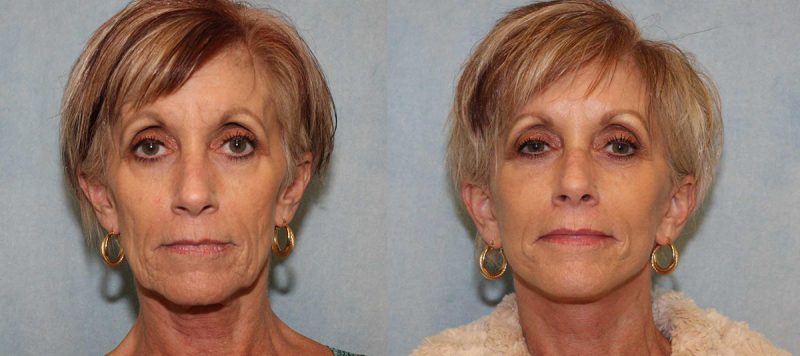 Facelift Patient 1 Image 3