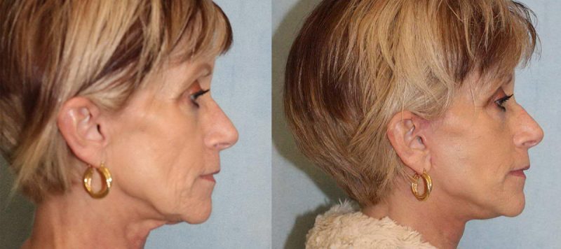 Facelift Patient 1 Image 2