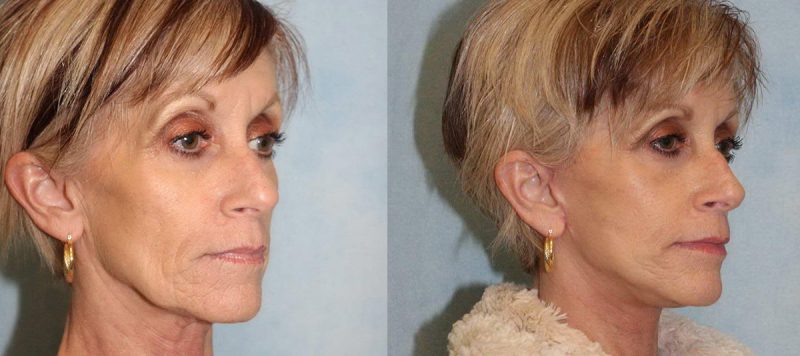 Facelift Patient 1 Image 1