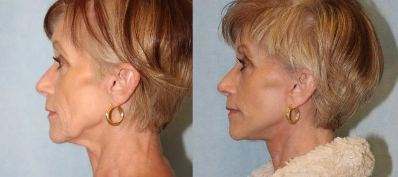 Facelift Patient 1 Image 0