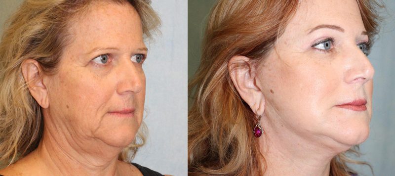 Facelift Patient 12 Image 3