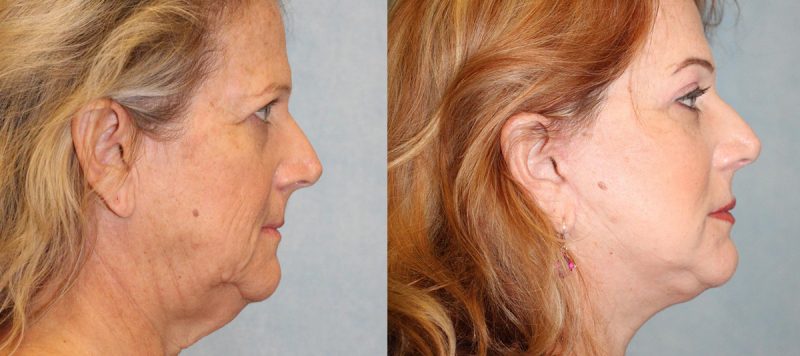 Facelift Patient 12 Image 2