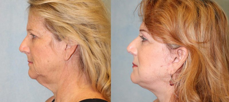 Facelift Patient 12 Image 0