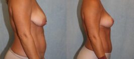 Mommy Makeover Before and After Photo 1