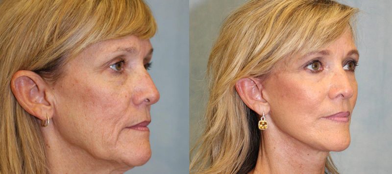 Facelift Patient 11 Image 4