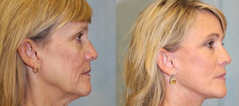 Facelift Patient 11 Image 3