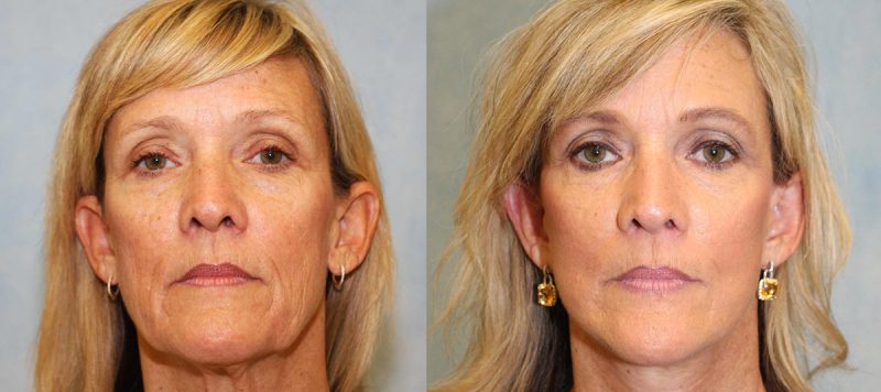 Facelift Patient 11 Image 0