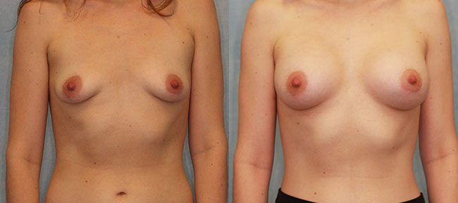 Breast Augmentation Patient 23 Image 3