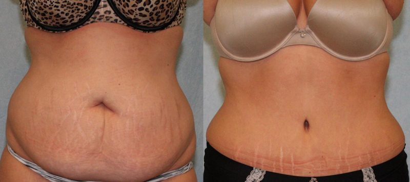 Abdominoplasty Patient 7 Image 3