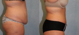 Tummy Tuck Before and After Photo 0
