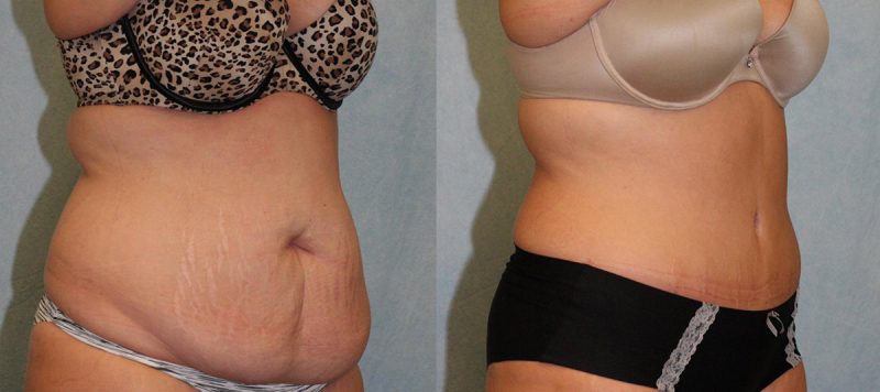 Abdominoplasty Patient 7 Image 1