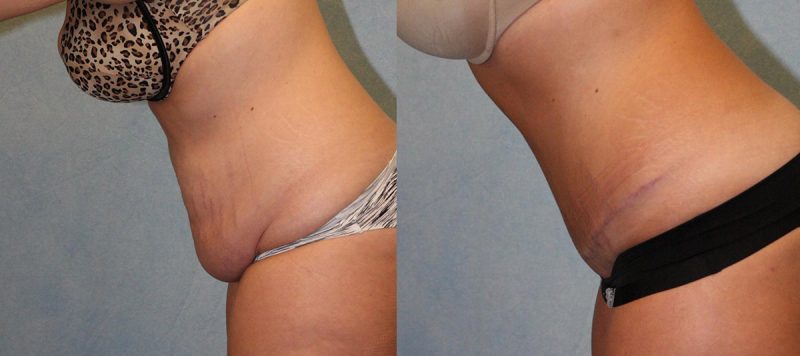 Abdominoplasty Patient 7 Image 0