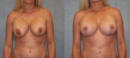 Breast Lift Before and After Photo 0