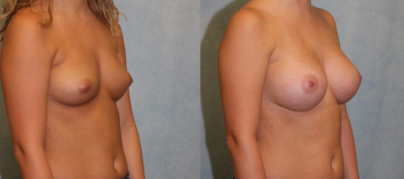 Breast Augmentation Patient 20 Image 1