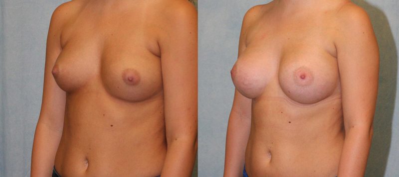 Breast Augmentation Patient 20 Image 0