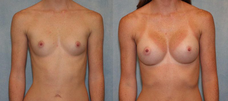 Breast Augmentation Patient 2 Image 3