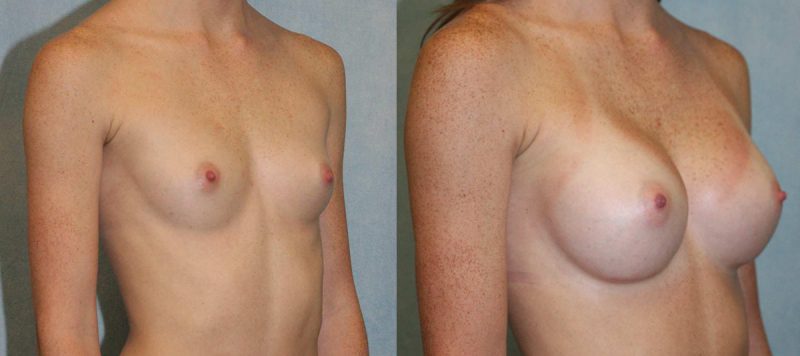 Breast Augmentation Patient 2 Image 1