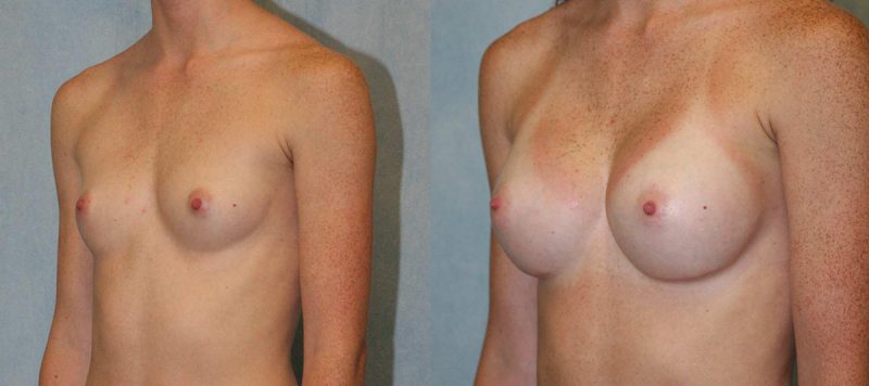 Breast Augmentation Patient 2 Image 0