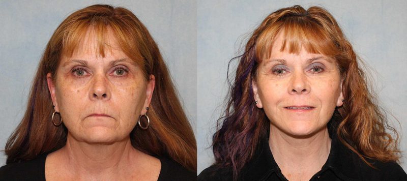 Facelift Patient 8 Image 0